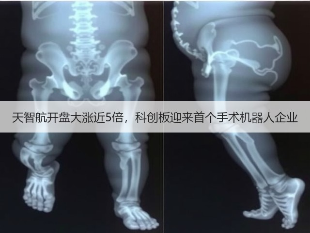 天智航开盘大涨近5倍，科创板迎来首个手术机器人企业(图2)