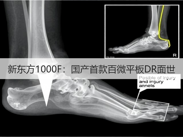 新东方1000F：国产首款百微平板DR面世(图1)