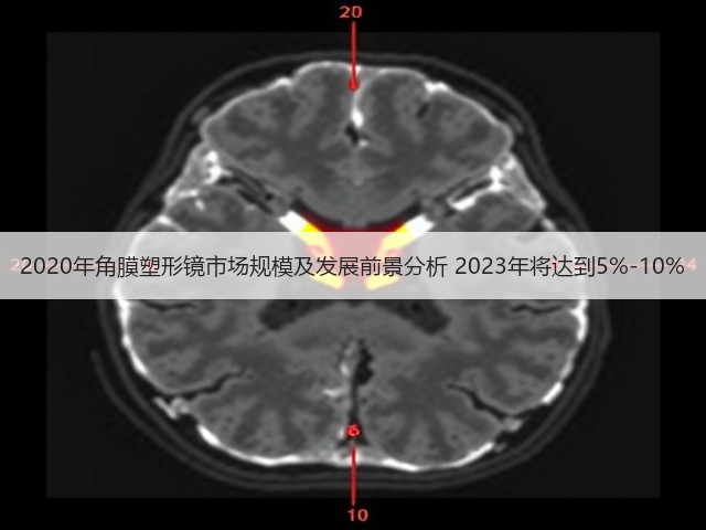2020年角膜塑形镜市场规模及发展前景分析 2023年将达到5%-10%(图1) 2020年角膜塑形镜市场规模及发展前景分析 2023年将达到5%-10%(图1)